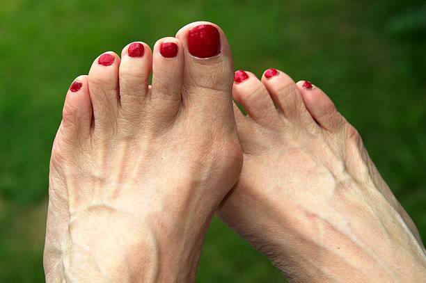 Understanding Common Foot Problems: Hammertoes and Bunions