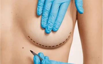 Necessity of Choosing London’s Best Breast Cancer Surgeons